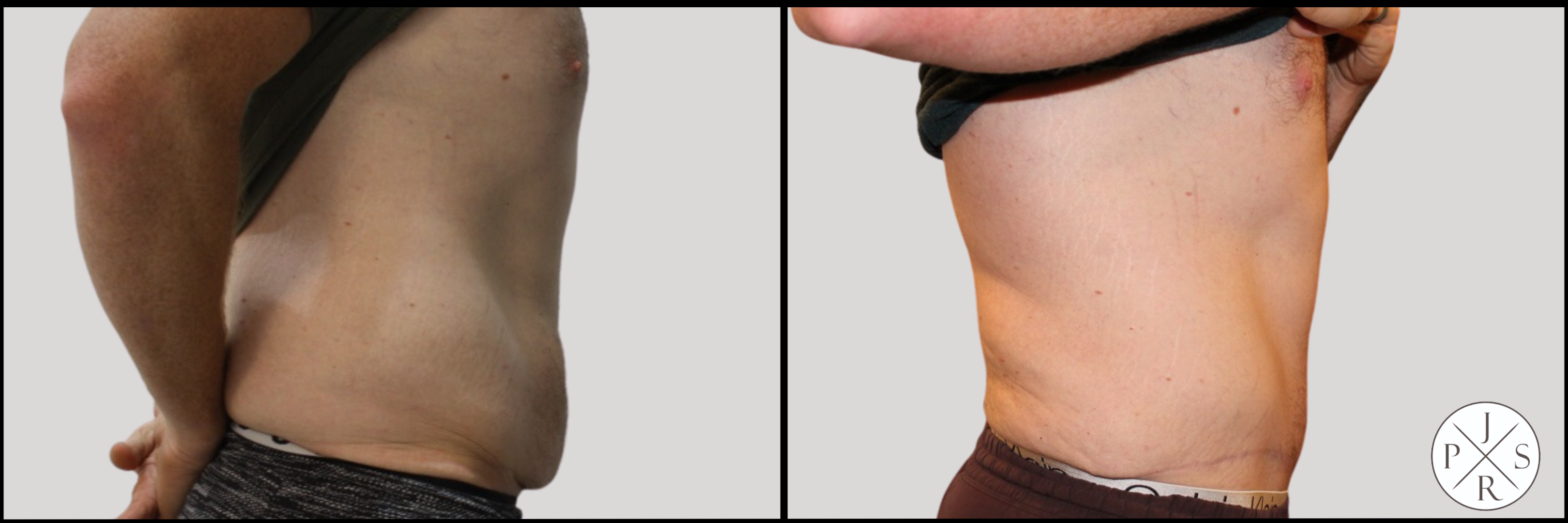 Abdominoplasty Before & After Image